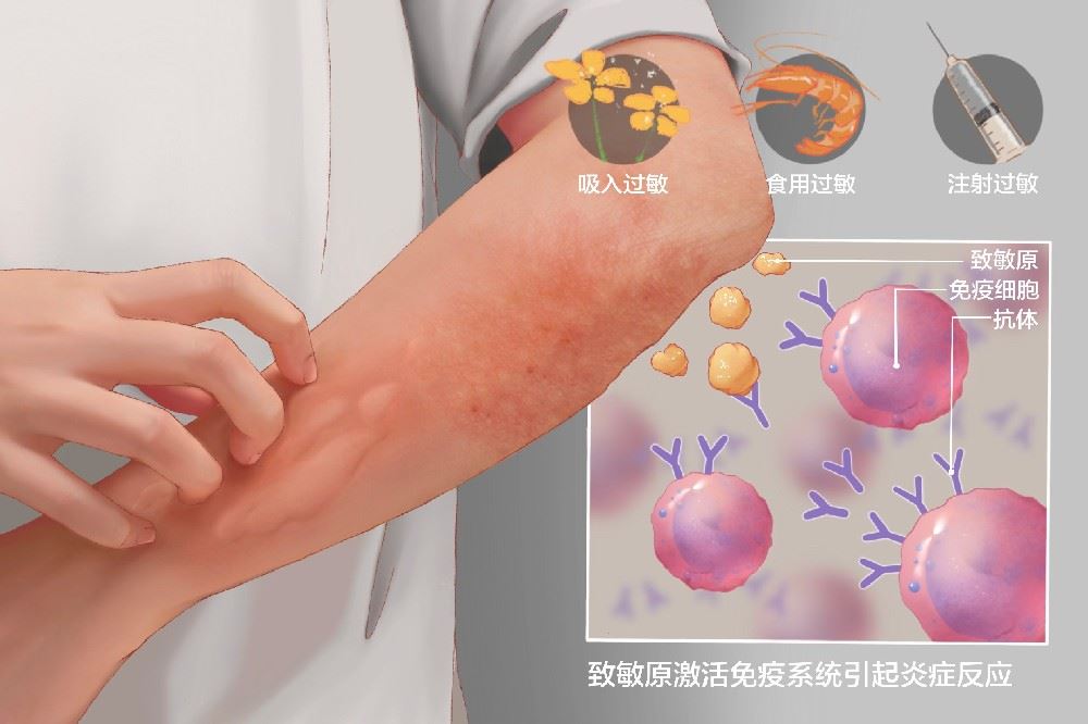 关于“过敏性皮炎”您知多少？